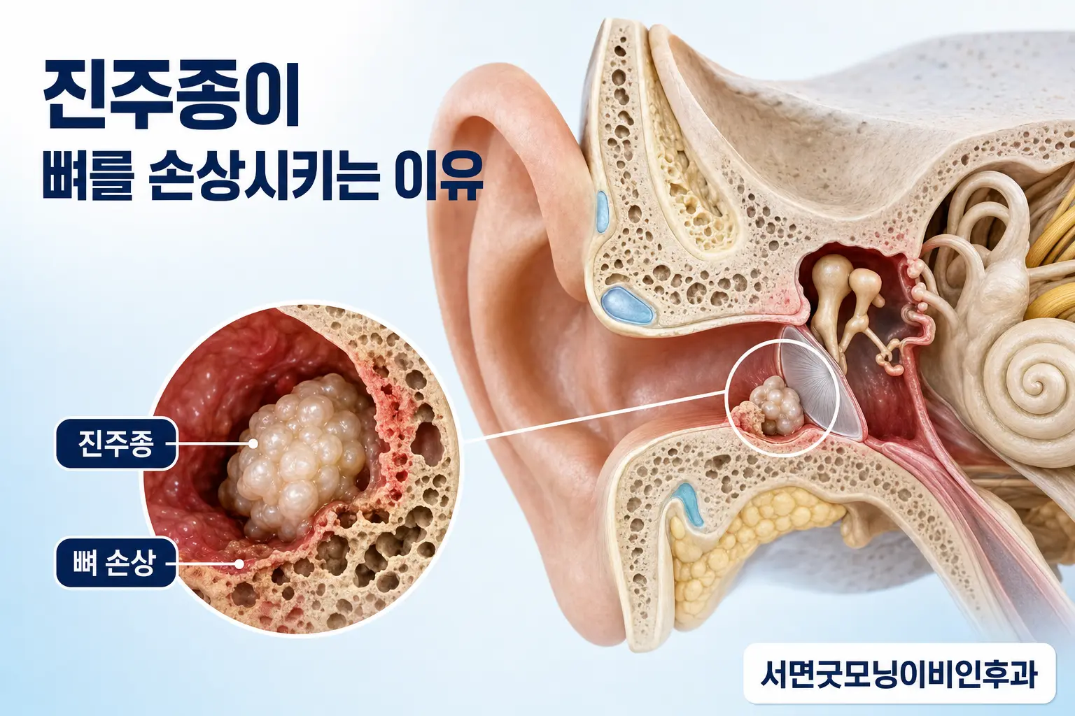 부산이비인후과 | 진주종성 중이염은 왜 뼈를 손상시킬 수 있을까요?