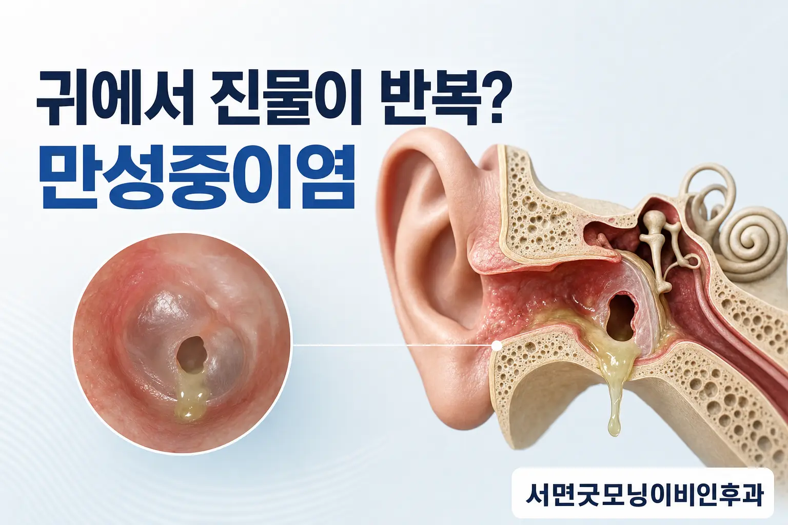 부산이비인후과 | 귀에서 진물이 반복되는 만성중이염의 검사와 치료