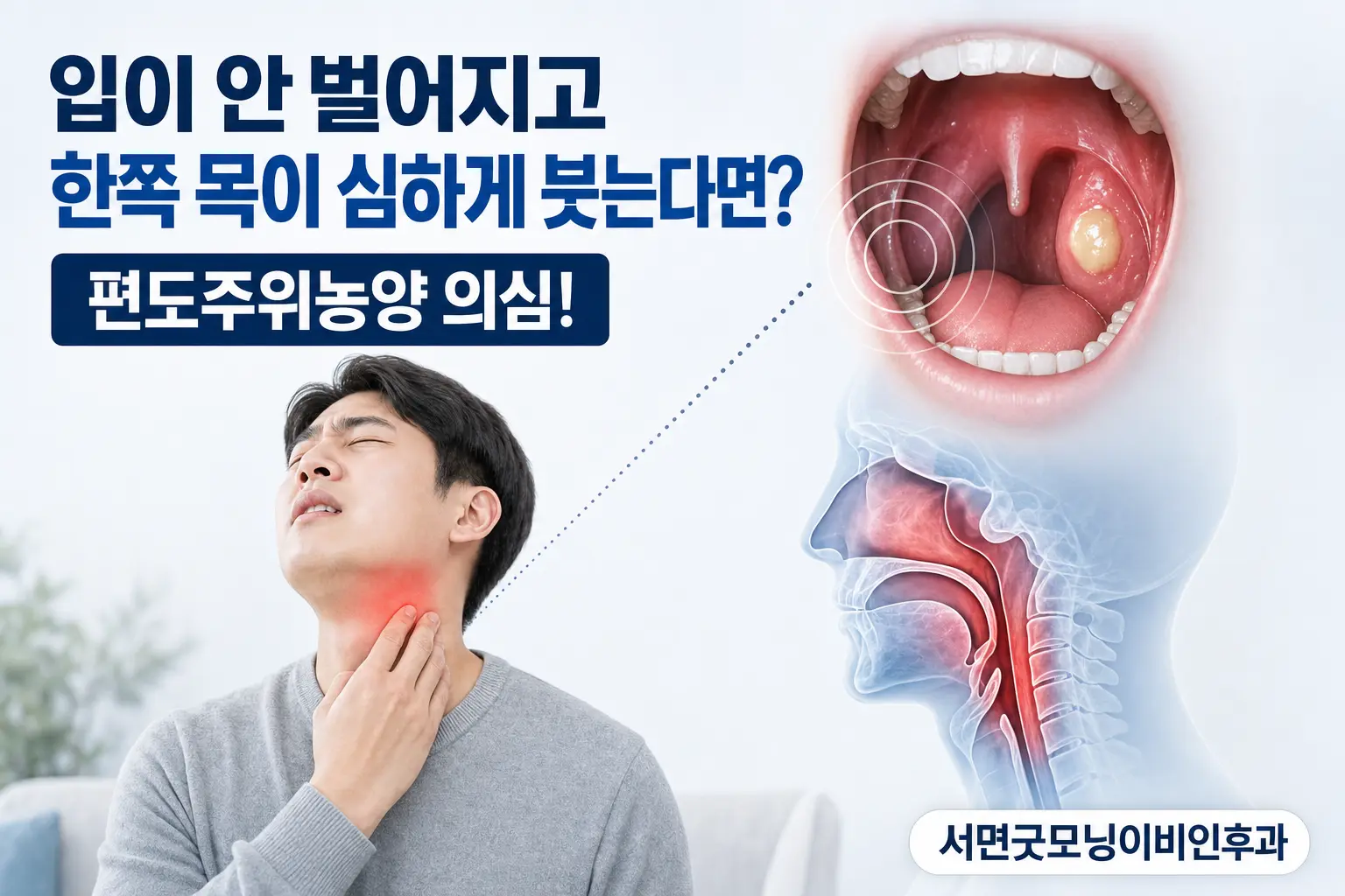 부산이비인후과 | 한쪽 목이 심하게 붓고 입이 안 벌어지면 편도주위농양일까요?
