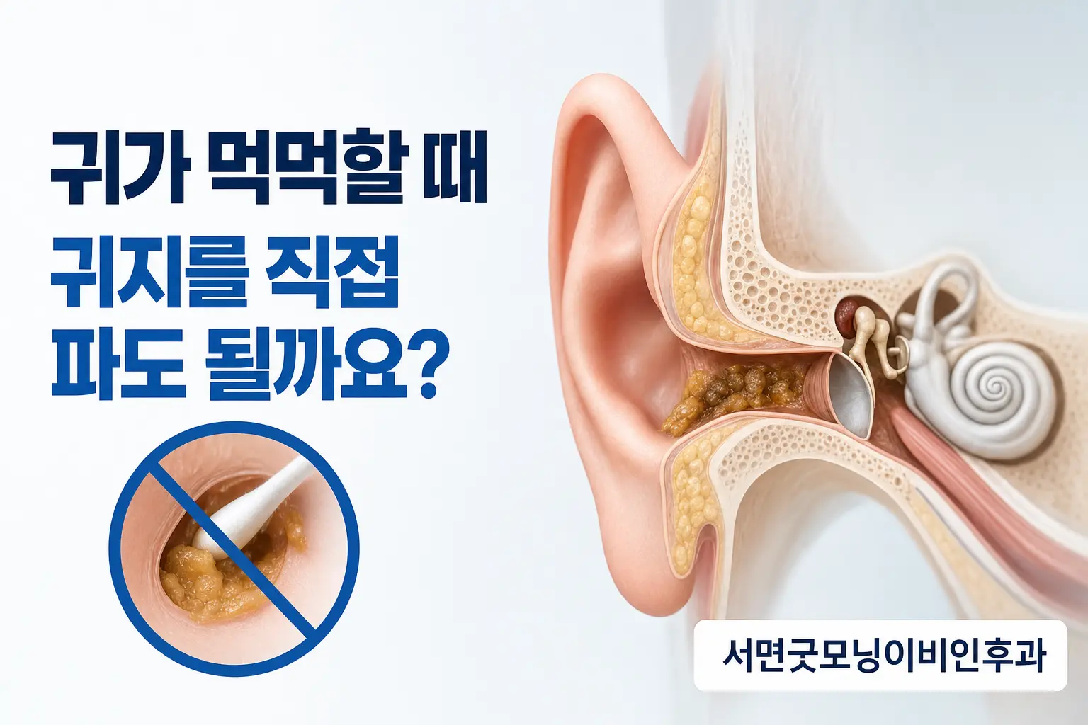 부산이비인후과 | 귀가 먹먹할 때 귀지를 직접 파도 될까요?