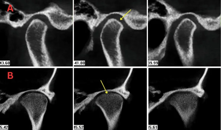 CBCT 단면에서 하악과두 윤곽이 약간 편평해지고 겉면 피질골이 얇아진 1단계 턱관절 변화 (논문 도판)