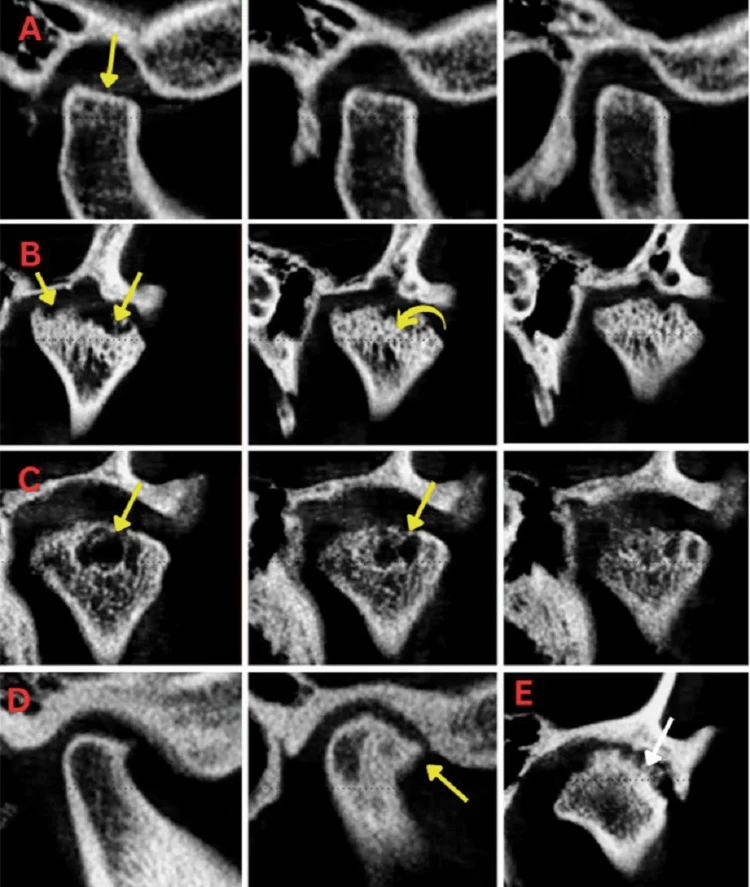 CBCT 단면에서 심한 편평화, 심한 침식 또는 다발성 침식, 가성낭종, 큰 골극, 피질골 경화가 보이는 3단계 턱관절 변화 (논문 도판)