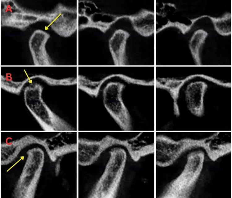 CBCT 단면에서 관절 머리가 중간 정도 편평해지고 작은 침식과 골극이 보이는 2단계 턱관절 변화 (논문 도판)