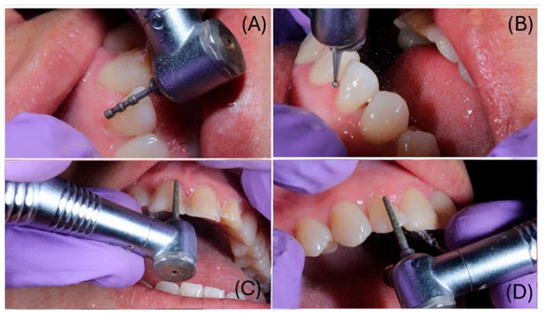 위 앞니 앞면에 0.6mm 깊이 홈을 내고 고르게 다듬는 라미네이트 삭제 과정 4컷 (논문 도판)