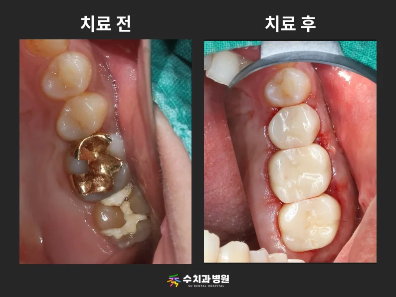 📸 치료 전후 비교 사진