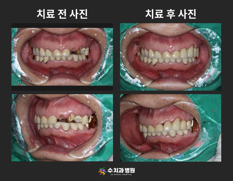 📸 치료 전후 비교 사진