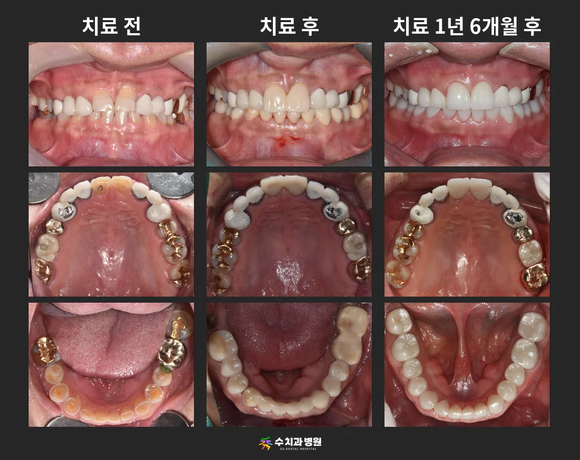 📸 치료 전후 비교 사진