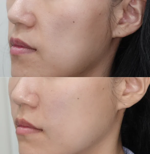 실제 볼패임 쥬베룩볼륨 효과