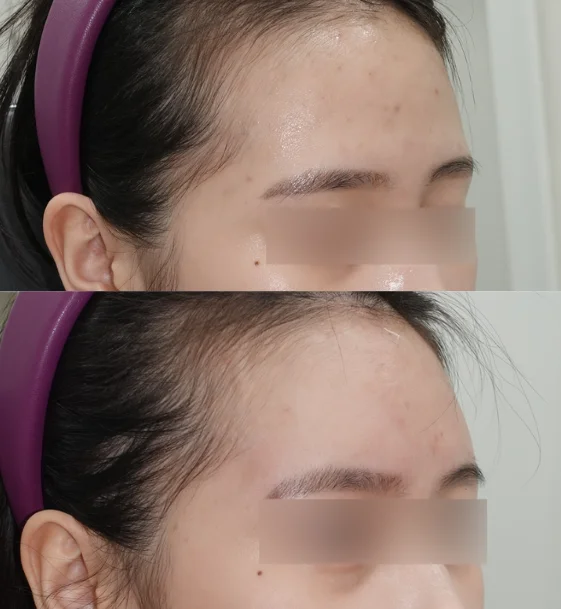 이마꺼짐은 필러 시술이 더 적합