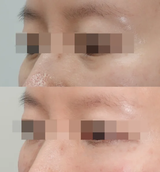 눈밑꺼짐은 쥬베룩볼륨 시술 시 부작용이 발생할 수 있는 부위