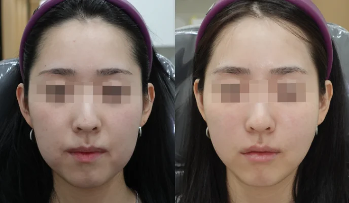 강남 오드의원 울쎄라 600샷 시술 사례