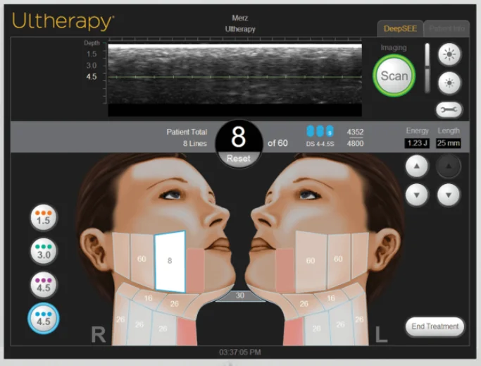 울쎄라 4.5mm 핸드피스 시술 범위 화면