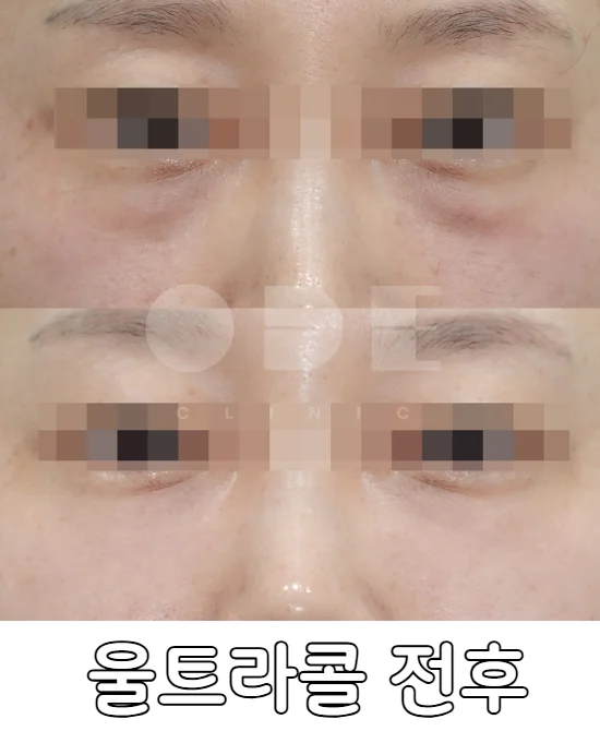 눈밑 울트라콜 200 전후 효과