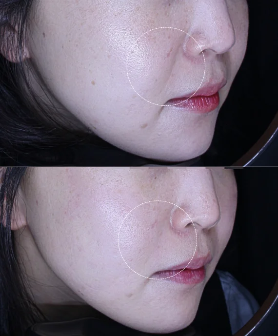 Before and After Xerf 300 shots