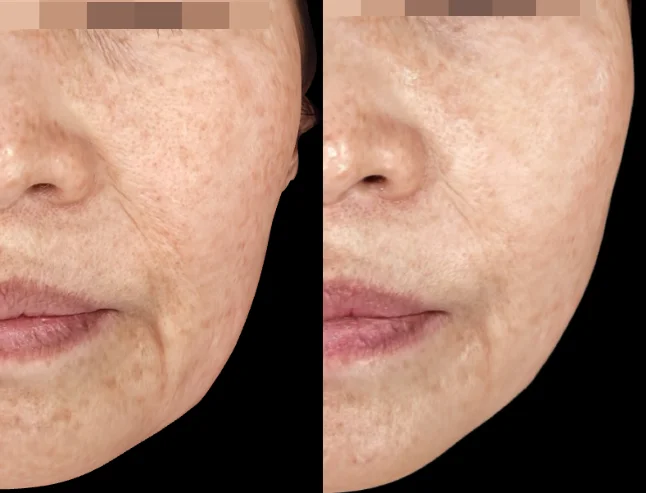 Before and After Xerf Lifting Treatment
