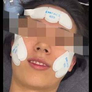 EMFACE treatment scene