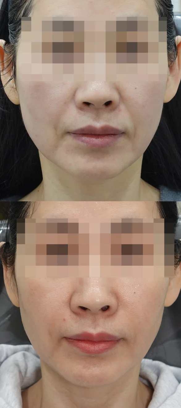 팔자주름 리프팅, 레디어스 시술 전후 사진