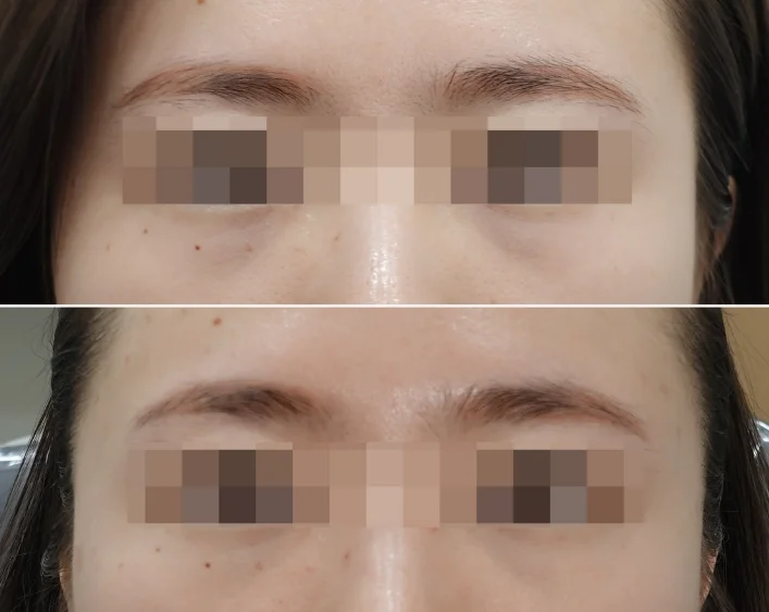 Before and After UltraColl Treatment