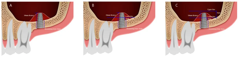 남은 뼈 4mm 위치에 10mm 임플란트를 두었을 때 6mm가 상악동 쪽으로 노출되는 모습을 그린 상악동 이식 부피 분석 모식도 (논문 도판)