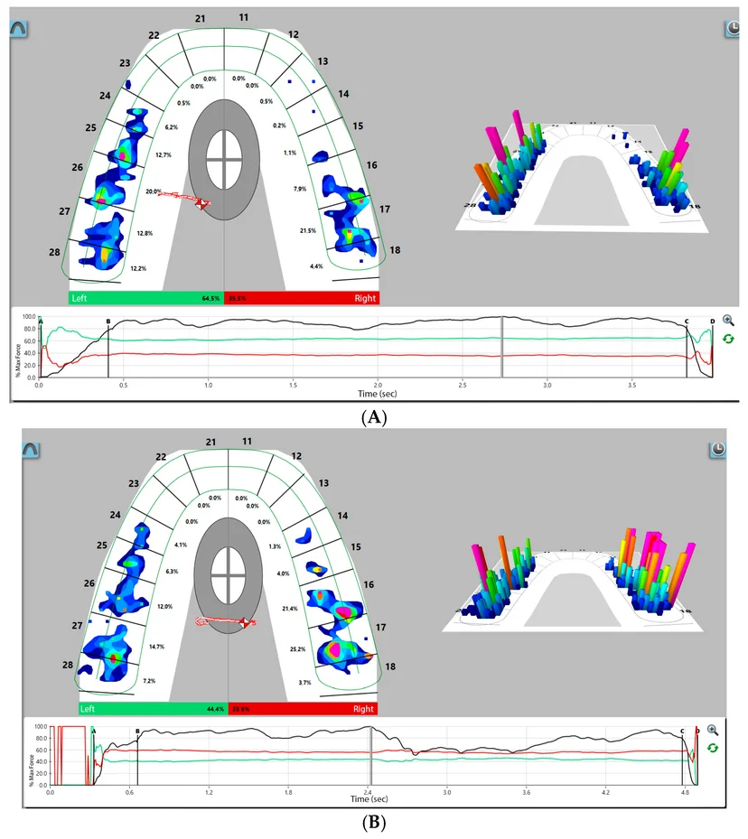 같은 환자의 T-Scan 기록에서 교합조정 전후 2차원·3차원 교합력 분포를 비교한 화면 (논문 도판)