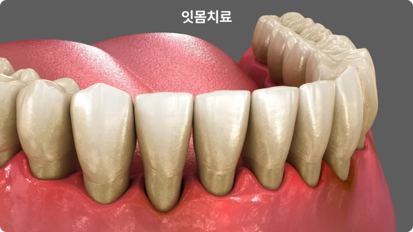 치석이 쌓이고 염증이 생긴 잇몸과 치주 조직을 보여주는 단면 일러스트 — 성모치과의원