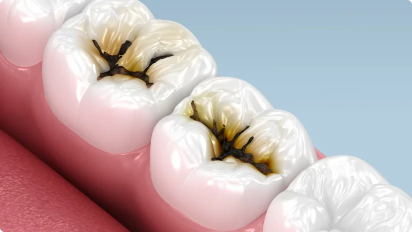 EMS Airflow 파우더 세정으로 치아 사이와 잇몸 경계의 플라크를 제거하는 장면 — 성북구 성모치과의원