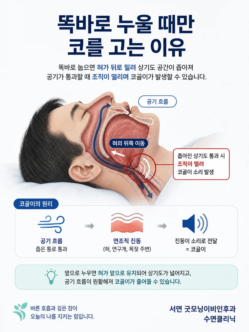 혀가 뒤로 이동해 상기도가 좁아지고 조직이 진동하는 코골이 원리 이미지