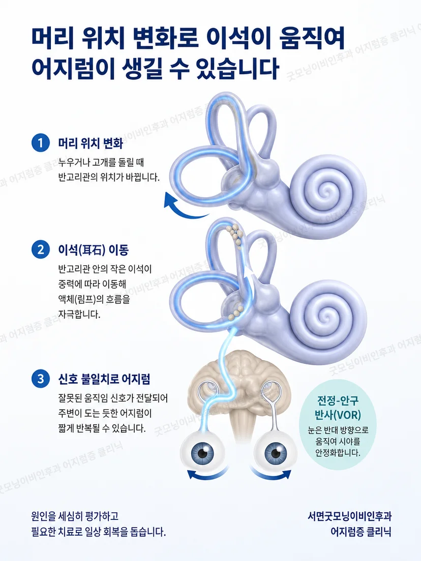 내이 반고리관과 이석 입자의 움직임을 설명하는 교육 이미지