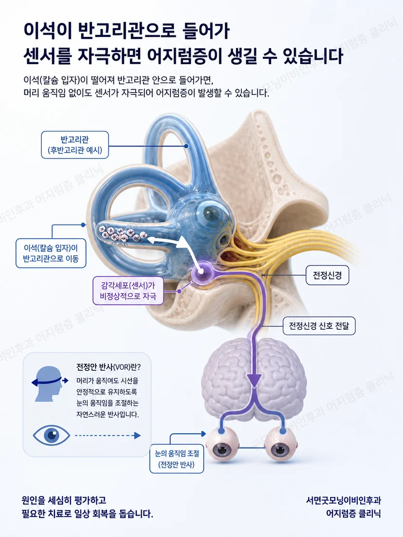 떨어진 이석이 머리 움직임에 따라 반고리관을 자극하는 원리