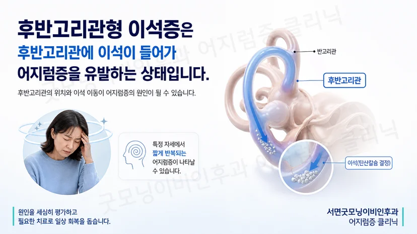 후반고리관형 이석증의 핵심 증상과 평가 원리를 설명하는 그림