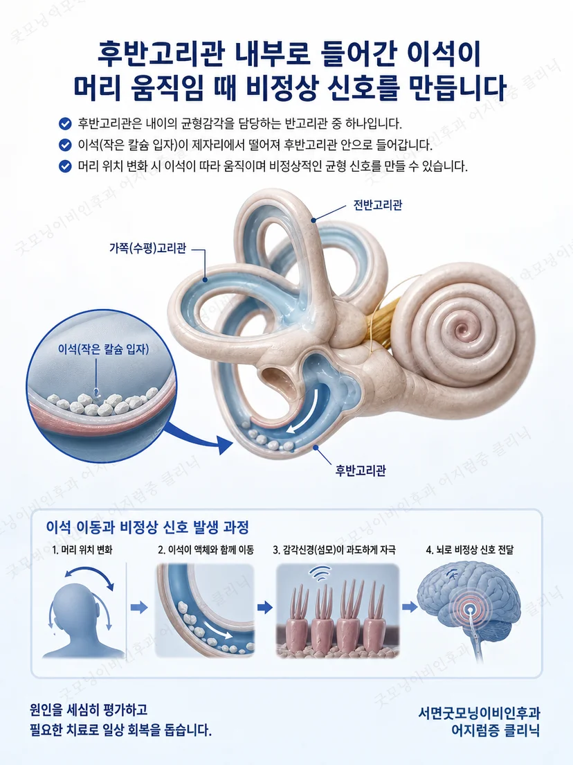 후반고리관의 위치와 이석이 이동하는 경로를 단순화한 해부 도식