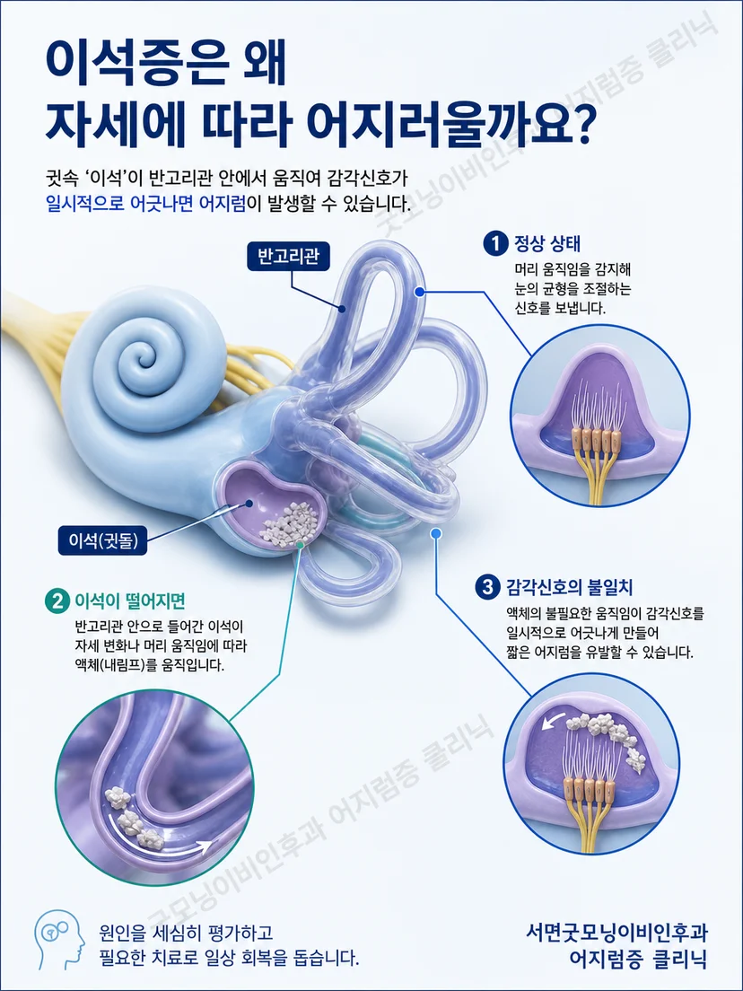머리 위치 변화와 이석증성 어지럼 및 안진의 관계를 설명한 그림