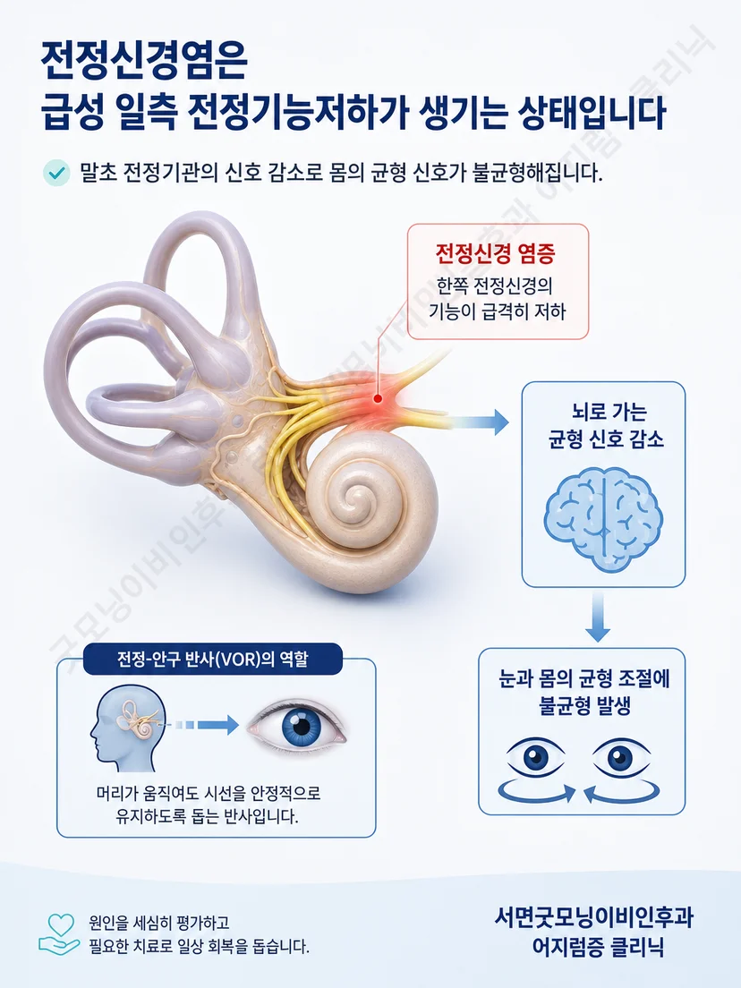 한쪽 전정기능 저하로 좌우 균형 신호가 불일치하는 원리 설명