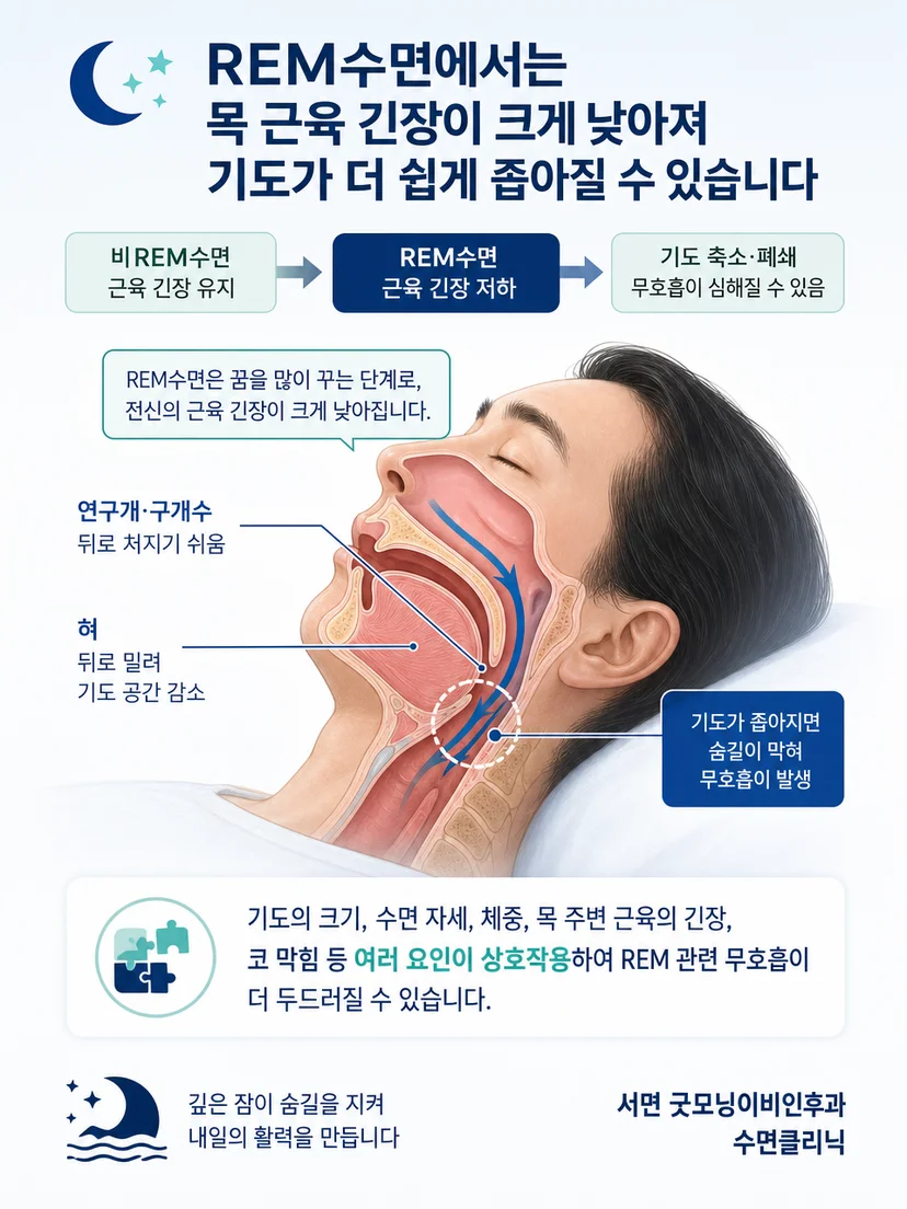혀와 연구개 위치 변화로 REM수면 중 상기도 단면이 좁아지는 원리