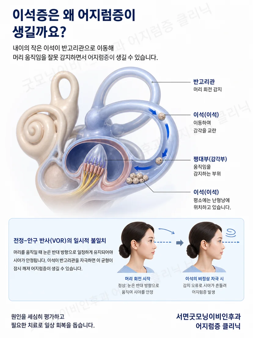 머리 위치 변화가 이석증의 회전성 어지럼을 유발하는 원리 설명