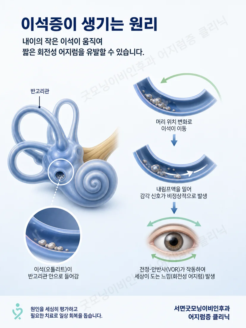 내이의 반고리관과 머리 위치 변화가 회전성 어지럼을 유발하는 원리 이미지
