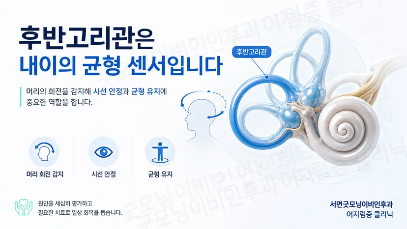 후반고리관의 균형 감지 역할과 이석증 발생 원리를 설명하는 핵심 이미지