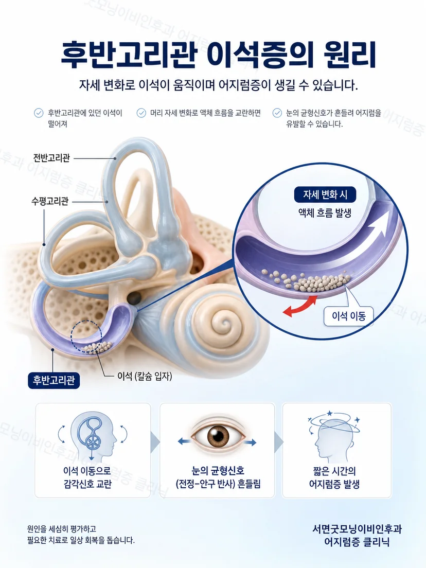 난형낭에서 후반고리관으로 이석이 이동하는 경로를 단순화한 내이 해부 도식