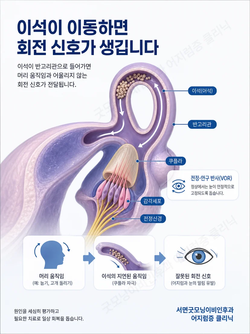 머리 위치 변화와 이석증 어지럼 발생 원리를 설명하는 그림