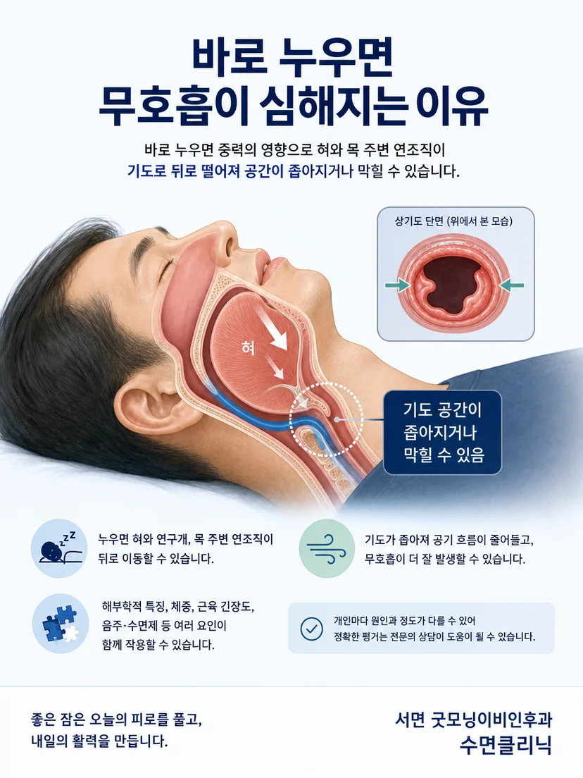 앙와위에서 혀와 연구개가 뒤로 이동해 상기도 단면이 좁아지는 원리