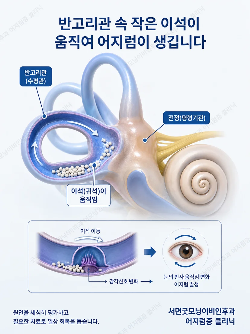 양쪽 내이와 반고리관에서 이석 위치가 달라질 수 있는 원리