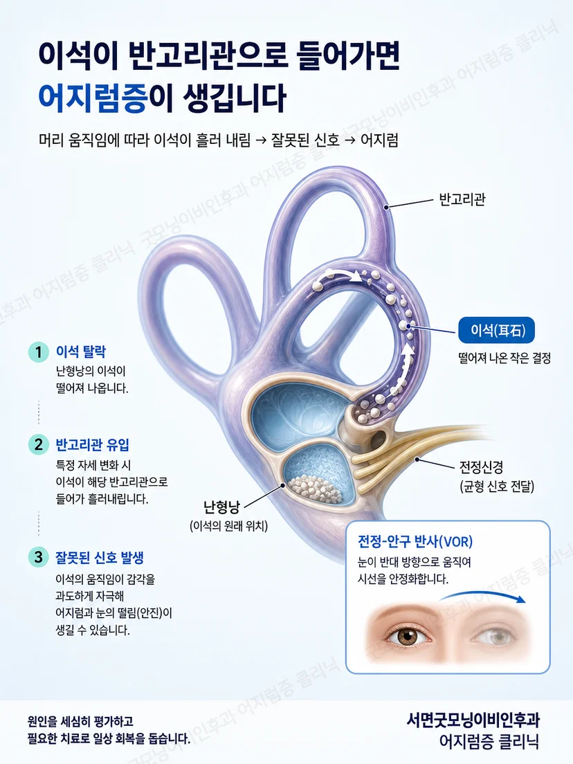 반고리관 안의 이석을 자세 변화로 이동시키는 원리