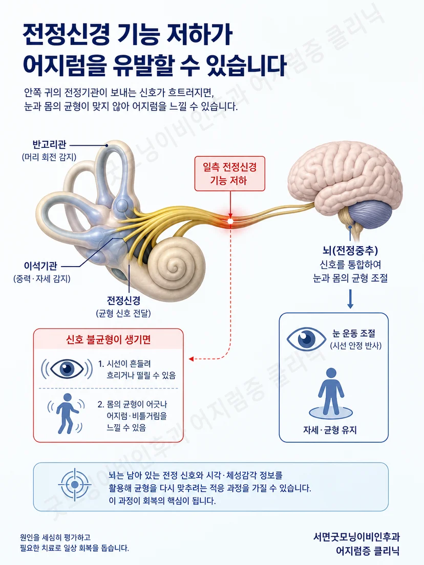 한쪽 전정 기능 저하와 뇌의 전정 보상 원리