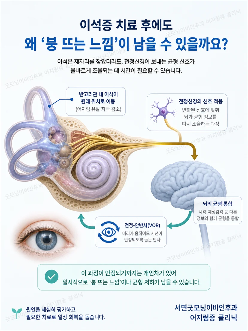 이석증 치료 후 균형 감각이 다시 적응하는 원리 설명