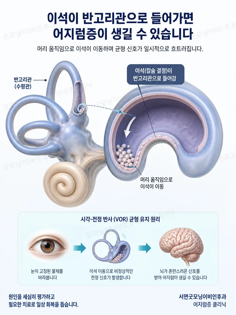 이석 입자와 반고리관의 위치 관계를 보여주는 교육 그림