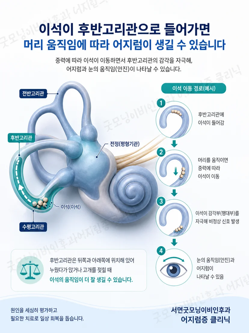 후반고리관의 위치와 자세 변화에 따른 이석 이동 경로 도식