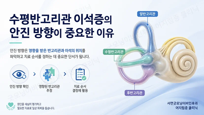 수평반고리관 안진 방향과 치료 판단의 관계를 설명하는 핵심 도식