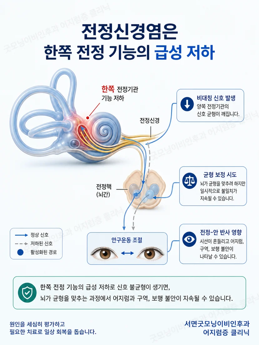 한쪽 전정기능 저하로 좌우 균형 신호가 달라지는 원리 이미지