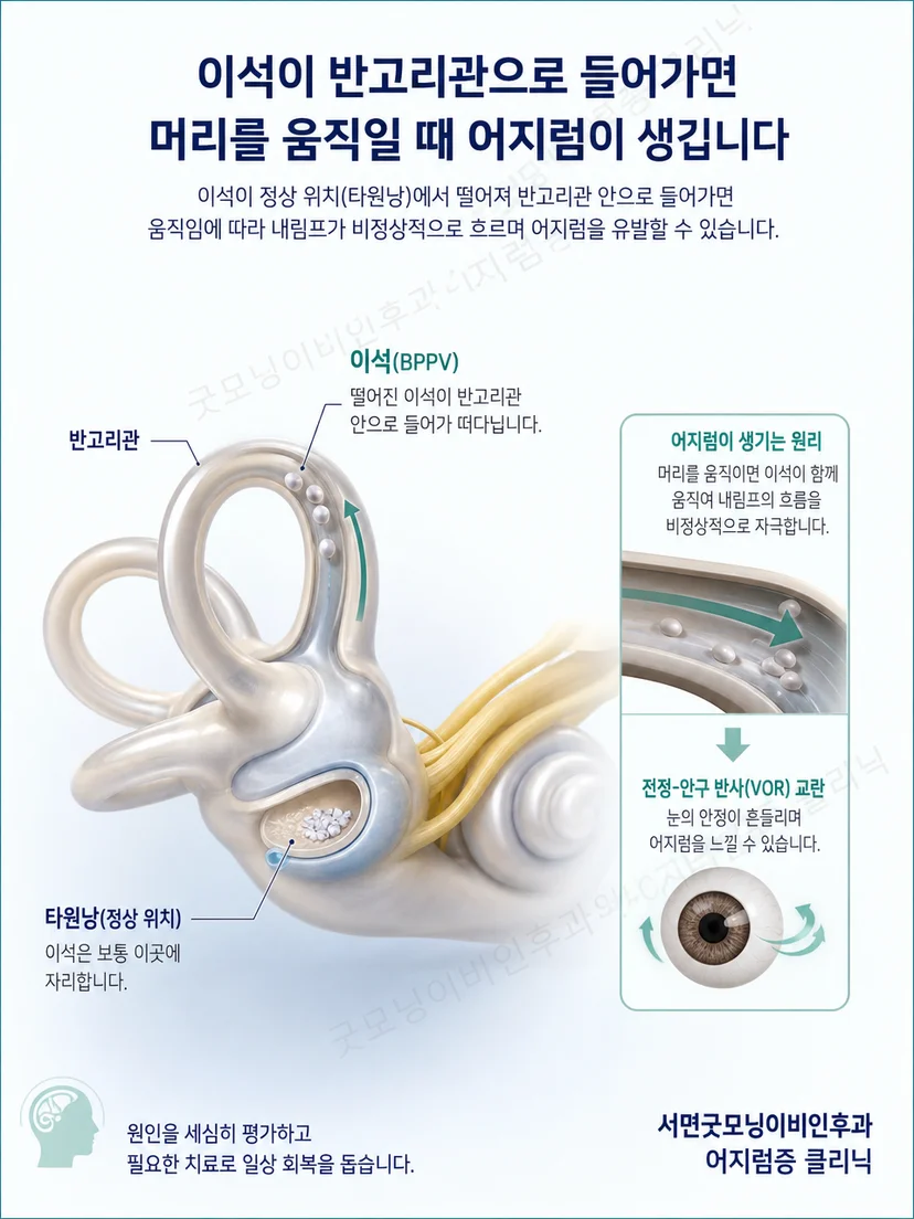 반고리관 안 이석의 이동과 자세 변화 원리를 설명하는 그림
