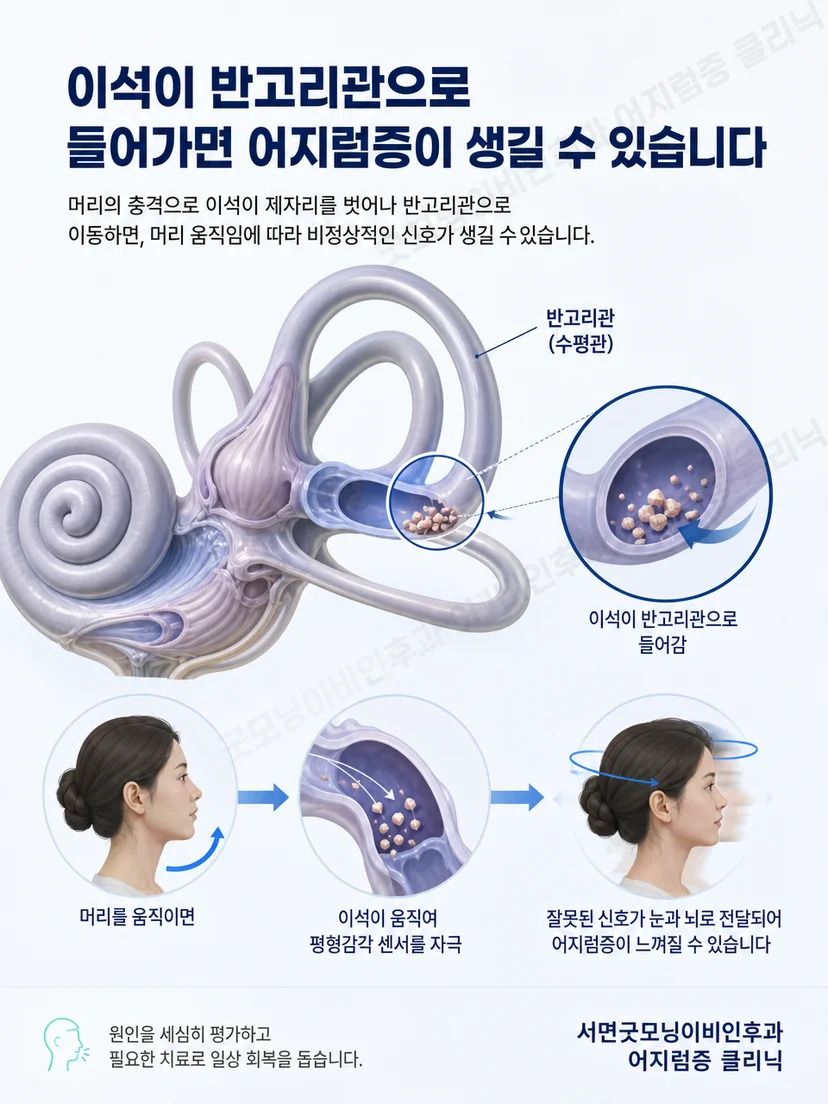 귀 안의 이석이 반고리관을 자극하는 원리 설명